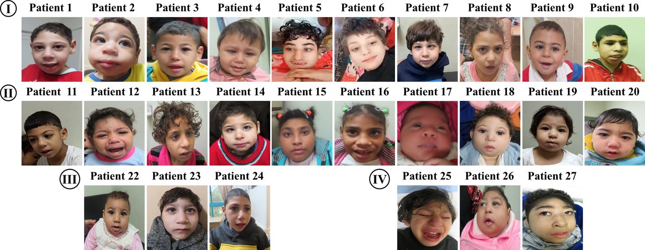 Refining the phenotypic spectrum of PNKP-related microcephaly: a